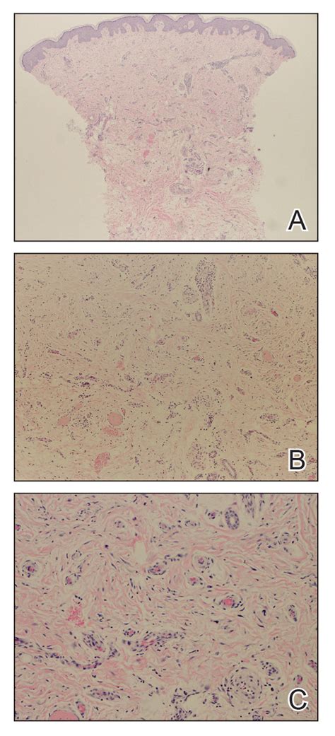 Nephrogenic Systemic Fibrosis in the Setting of Transient Renal ...