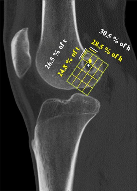 A higher posterior tibial slope and tunnel malposition do not ...