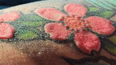 Hypothyroidism warning: Skin changes that shouldn’t be ignored