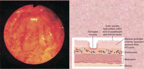 med surg ch 40- management of pts with gastric and duodenal disorders ...