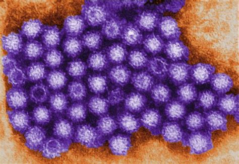 Winter vomiting disease caused by norovirus surging in US: Symptoms ...