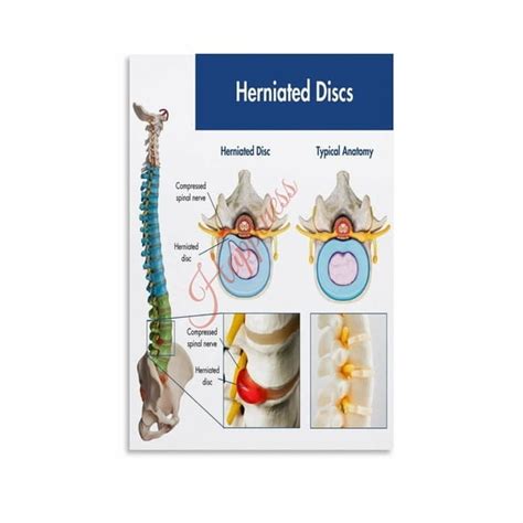 Lumbar Herniated Disc Visual Chart Symptoms Guide Poster Clinic Office ...