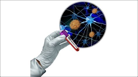 Predicting Alzheimer's: How a simple blood test could change your life ...
