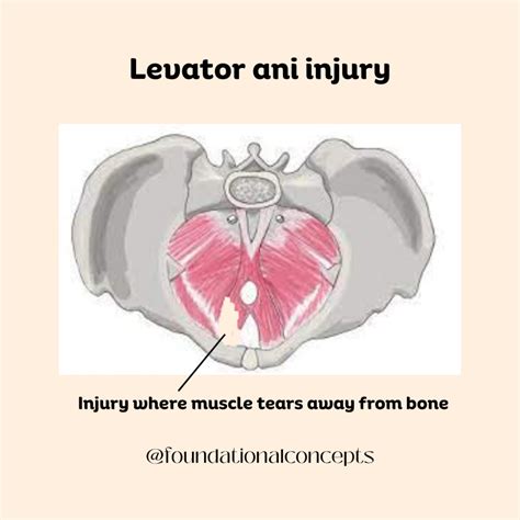 What Most Women (and Even Providers) Miss About Back Pain After ...