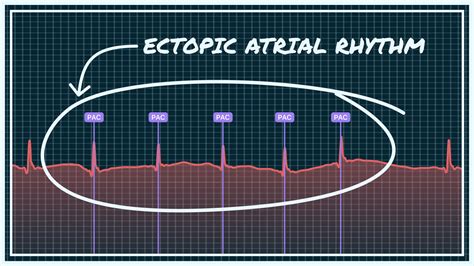 Ecg Electrode Locations at Marvin Wolbert blog - Face Surgery
