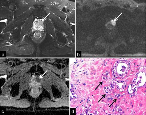 Apparent diffusion coefficient values in prostate cancer: Association ...