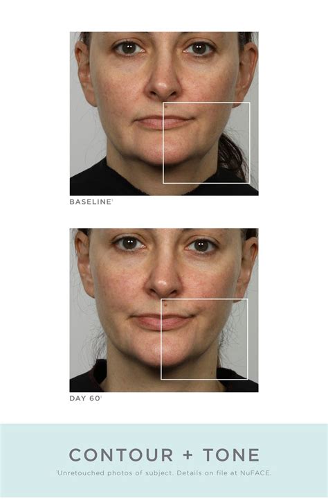 NuFACE® NuFace Refreshed Trinity Kit - White - Refurbished | Nordstromrack