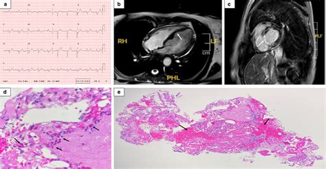 Induction therapy with mepolizumab for cardiac involvement in eosinophilic granulomatosis with ...