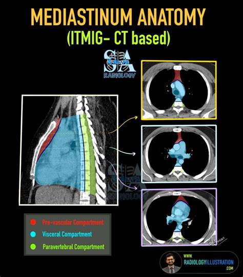 Radiological anatomy of Mediastinum. Wrote an article on website with ...