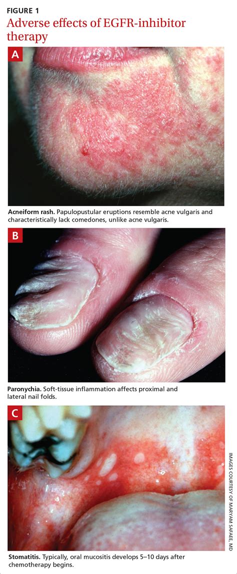 Managing dermatologic changes of targeted cancer therapy | MDedge