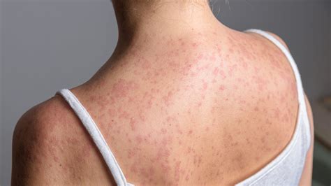 New Michigan measles case: Others exposed at Briarwood Mall, gym