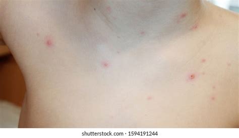 51 Ilustrasi, Foto Stok, dan Gambar Chicken pox stage Tanpa Royalti ...