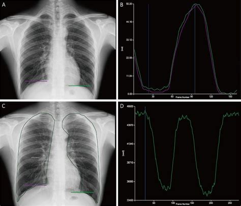 Dynamic chest radiography effective for diagnosing COPD | AuntMinnie