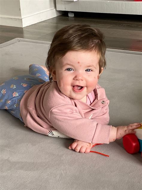 Auckland baby’s rare birthmark disease: Parents’ fight to save little Livi’s life