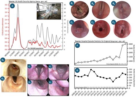 Laryngotracheal stenosis and malacia care | ENT & Audiology News