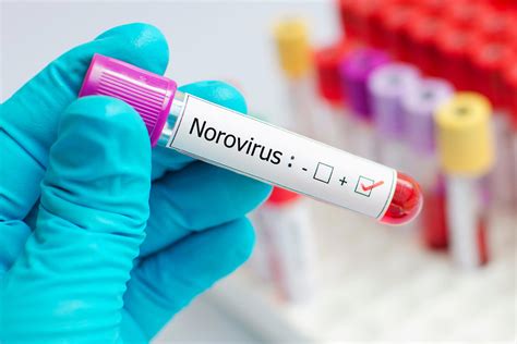 Doctors warn of early surge in highly contagious norovirus
