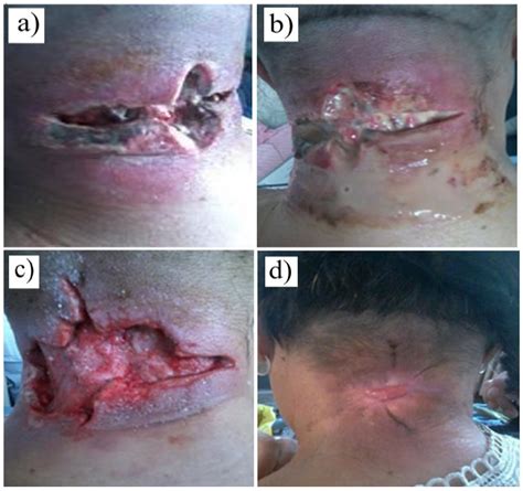 Chronic Wound Management: Surgical Therapy and Complementary Nursing ...