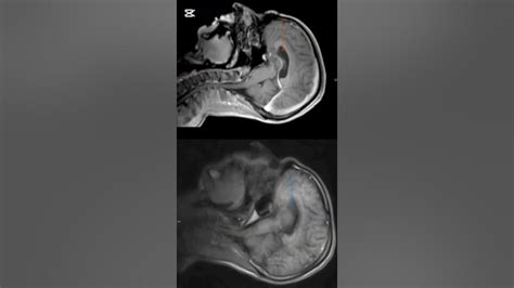MRI Comparative Images – Documented Case (30+ Years) - YouTube