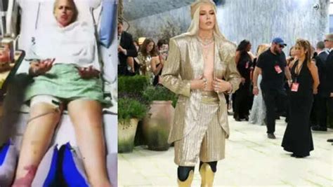 Lauren Wasser’s golden legs spark viral debate around toxic shock ...
