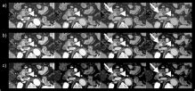Optimizing Delayed-Phase CT Strategies for Early Pancreatic Ductal ...