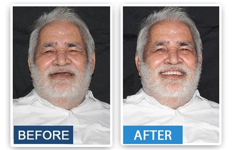 Affordable Dental Implants service in Gurgaon | Symmetry Dental
