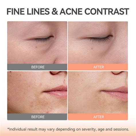 For TOUCHBeauty Trend Project Handheld Silicone LED Light Therapy ...