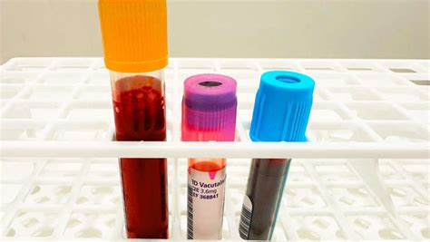 Metformin trial shows reduced insulin needs in type 1 diabetes