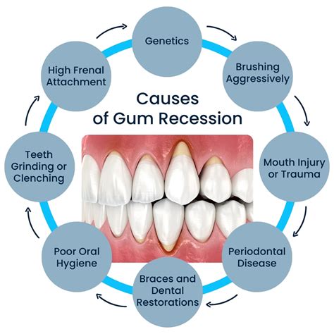 How to Prevent Receding Gums and Maintain Healthy Gums ⋆ ctf.bnsf.com