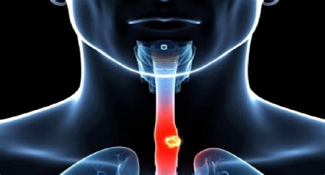 Erectile dysfunction drugs may help treat oesophageal cancer: Study