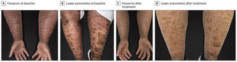 Lamellar Ichthyosis Improvement With Acitretin and Dupilumab ...