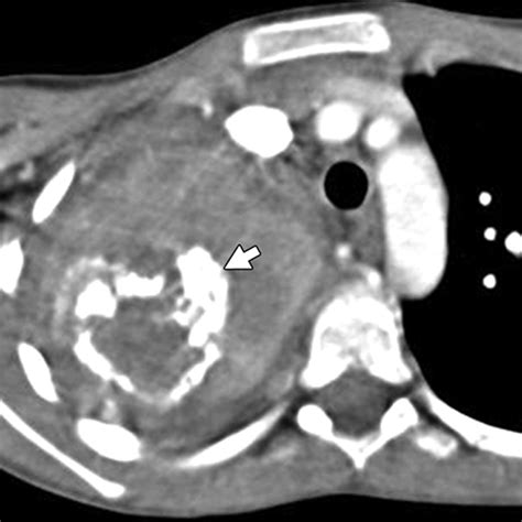 Inflammatory Pseudotumor: The Great Mimicker | AJR
