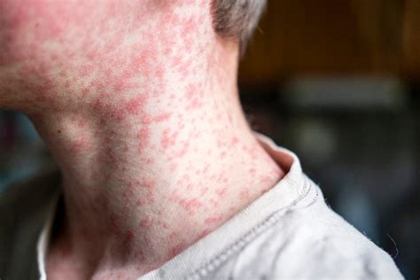 Measles can cause immune amnesia.