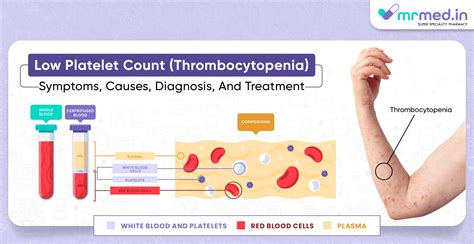 Platelets Normal Range - Face Surgery