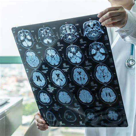 Signs of a Brain Injury After a Car Accident