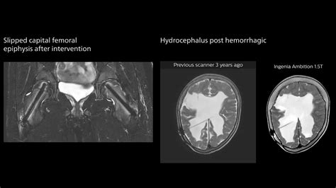 Slipped capital femoral epiphysis after intervention and hydrocephalus ...
