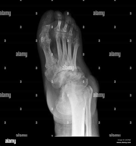 Charcot foot. X-ray of the foot of a 69 year old male patient with neuropathic arthropathy of ...