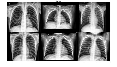 Image result for Normal X-ray