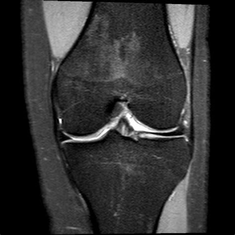 Mri Knee Coronal