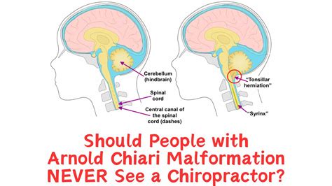 Should People with Arnold Chiari NEVER See a Chiropractor? - Revive Upper Cervical Chiropractic