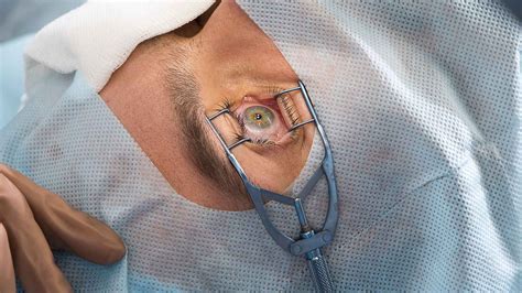 Are You Awake During Laser Eye Surgery? What to Expect