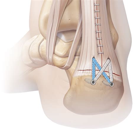 Image result for Tissue Fixation