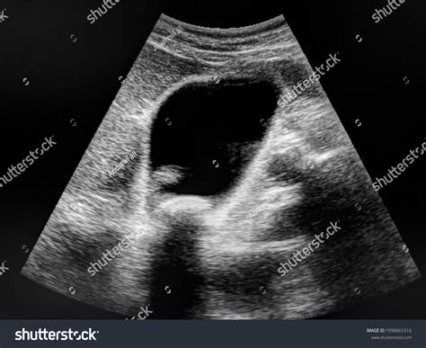 Choledocholithiasis Ultrasound