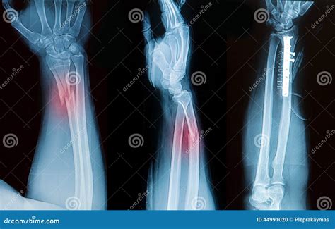 X-ray Image Of Forearm,lateral View, Show Fracture Of Ulna And R Royalty-Free Stock Photo ...