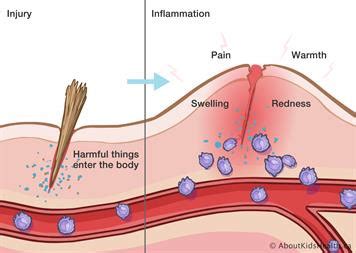 Image result for Inflammation Reaction