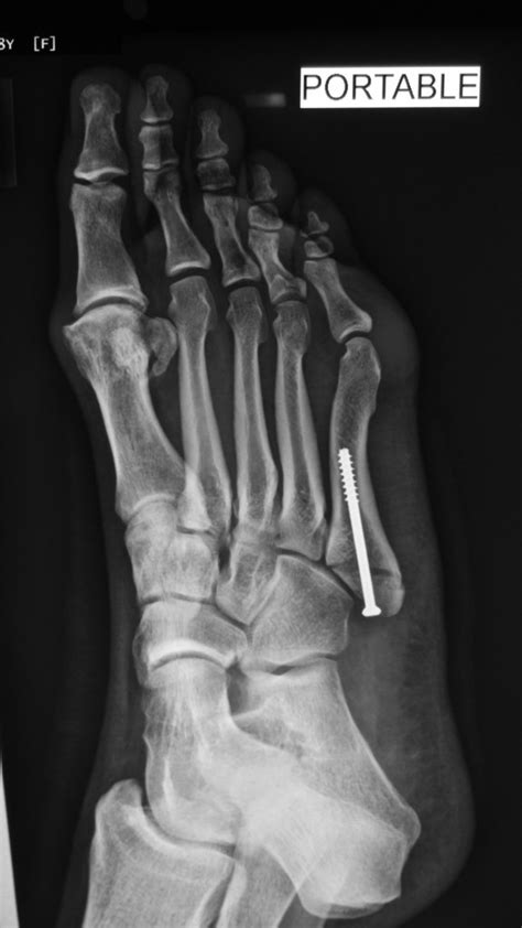 5th Metatarsal Base Displaced Fracture | HC Chang Orthopaedic Surgery | Singapore