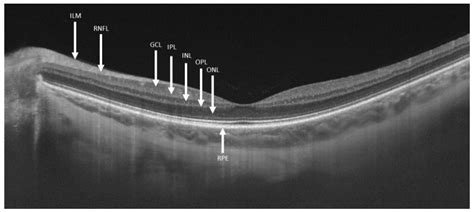 Retinal Layers Oct - layers of retina oct