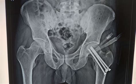 Hip Fractures Surgery in Ahmedabad | Dr. Rachit Sheth