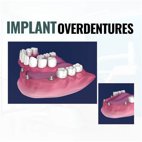 Understanding Implant Overdentures: Benefits, Procedure, and...