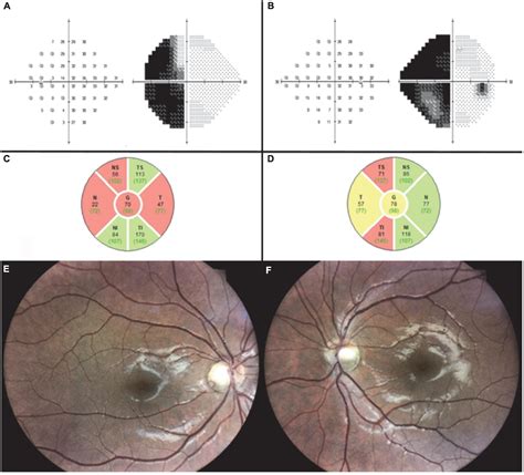 Image result for Nasal Step Visual Field Defect