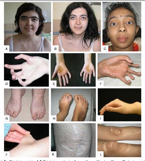 Ehlers-Danlos Syndrome _ Ehlers-Danlos‘ syndrom – MSKGCN